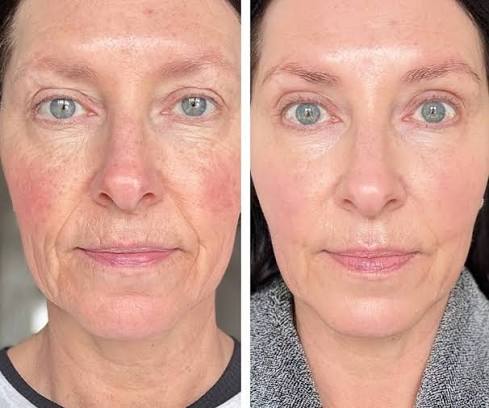 Before and after