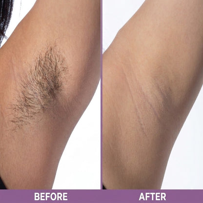 Cyperus Rotundus Oil for Hair Removal