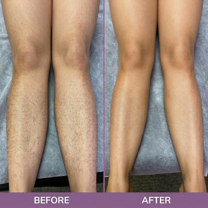 Cyperus Rotundus Oil for Hair Removal